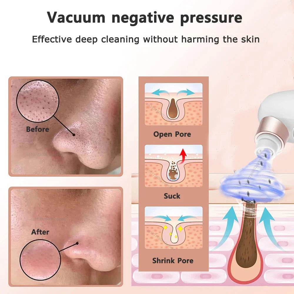 Electric Blackhead Remover Vacuum - Pore Face Cleaner